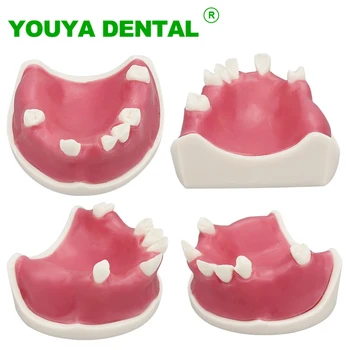 Модель зубного имплантата, обучающая модель для реставрации зубов, Typodont с мягкими деснами, демонстрационные модели стоматологической практики